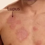 Foto : Ilustrasi Orang Terkena Lupus_net