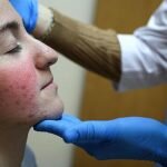 Foto : Ilustrasi Pengobatan Lupus_net